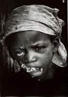 Enfant atteint du Noma